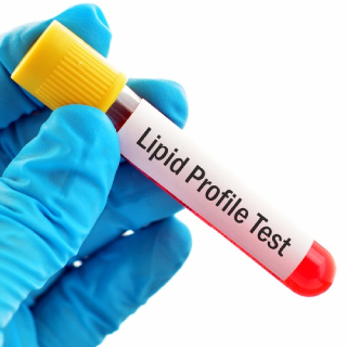 Lipid Profile (6 Tests) Worth Rs.650 at just Rs.549+ Rs.100 GP Cashback